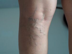 Laser: uma nova luz de esperança no tratamento de derrames