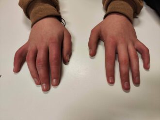 Síndrome de Raynaud: Como se trata?